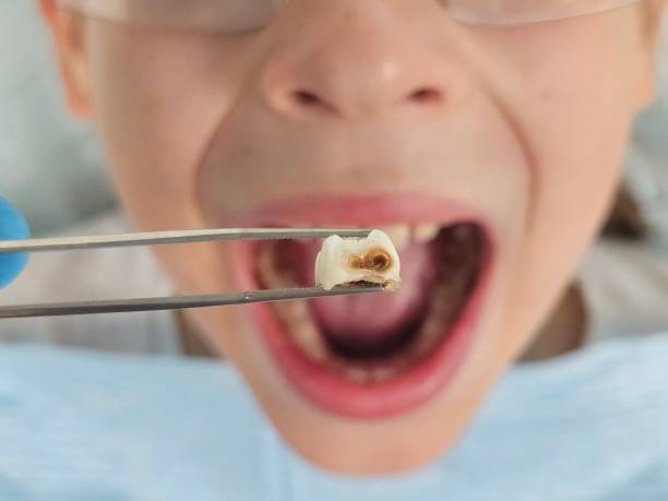 Best Emergency Treatment for Oral Infections in Dix Hills, NY